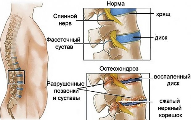 Если отекают ноги и болит спина