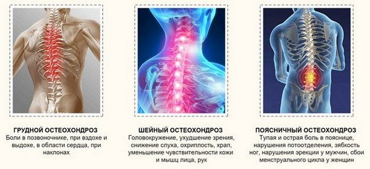 Локализация остеохондроза у человека Виды остеохондроза