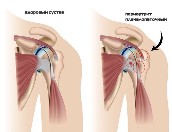 Отличие здорового сустава от пораженного плечелопаточным периартритом Плечелопаточный периатрит