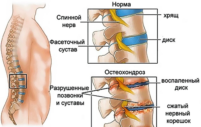 Остеохондроз Остеохондроз