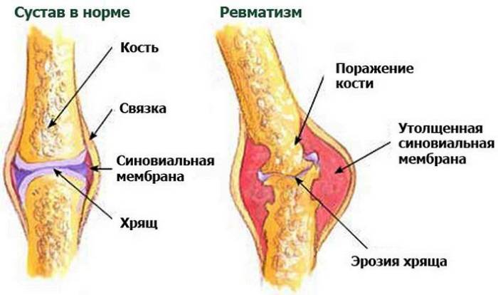 Ревматизм