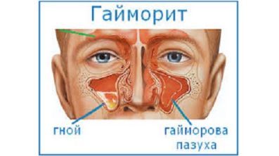 При температуре болят мышцы спины