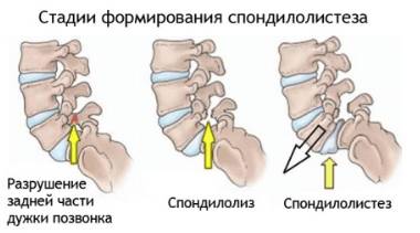Если ночью болит спина что это