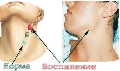 При температуре болят мышцы спины