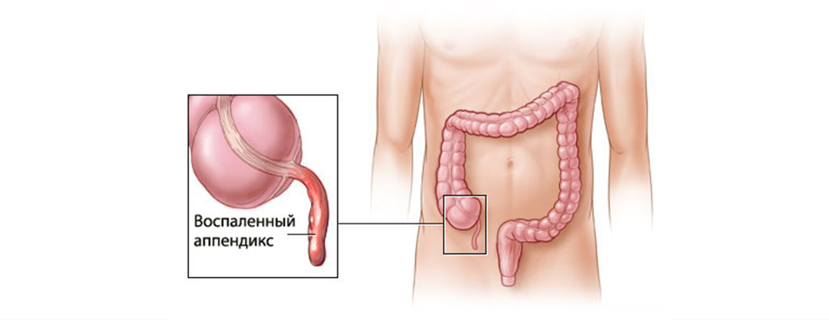 Аппендицит Аппендицит