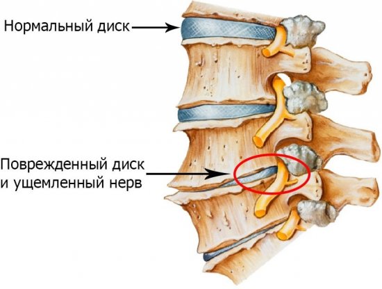 Остеохондроз