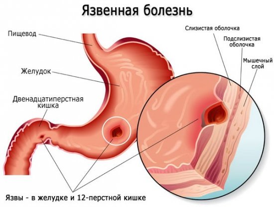 Язвенная болезнь желудка