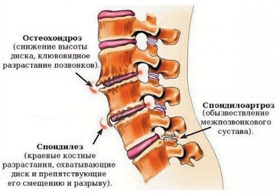 Различия остеохондроза, спондилеза и спондилоартроза