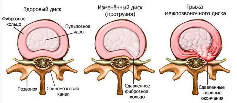 Болит середина позвоночника отдавая в спину