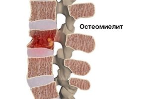 При температуре болят мышцы спины