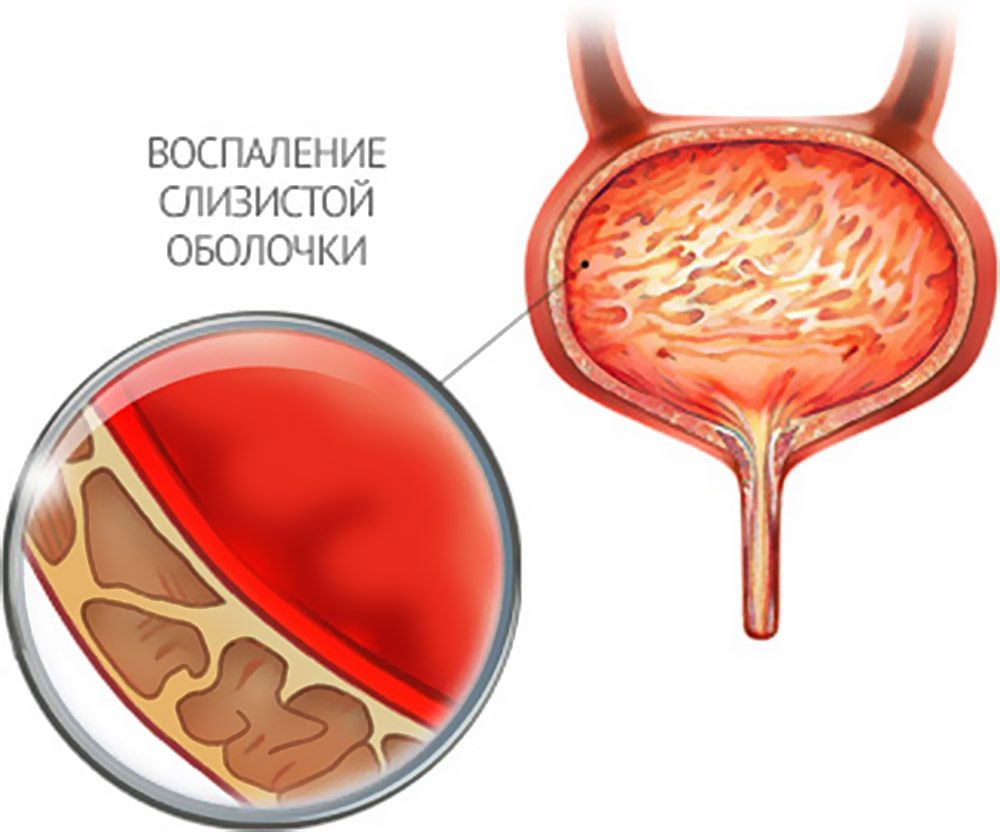 Цистит Цистит