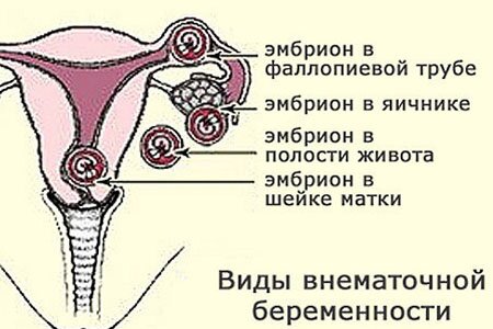 Внематочная беременность Внематочная беременность